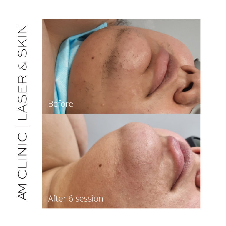 laser hair remove from chin before and after