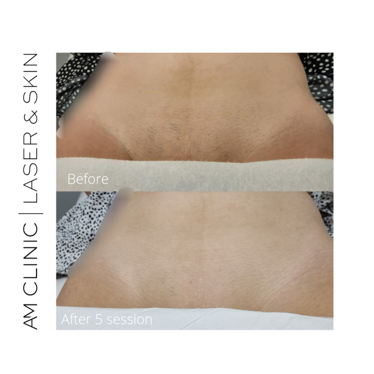 laser hair remove bikini line before and after 5 sessions