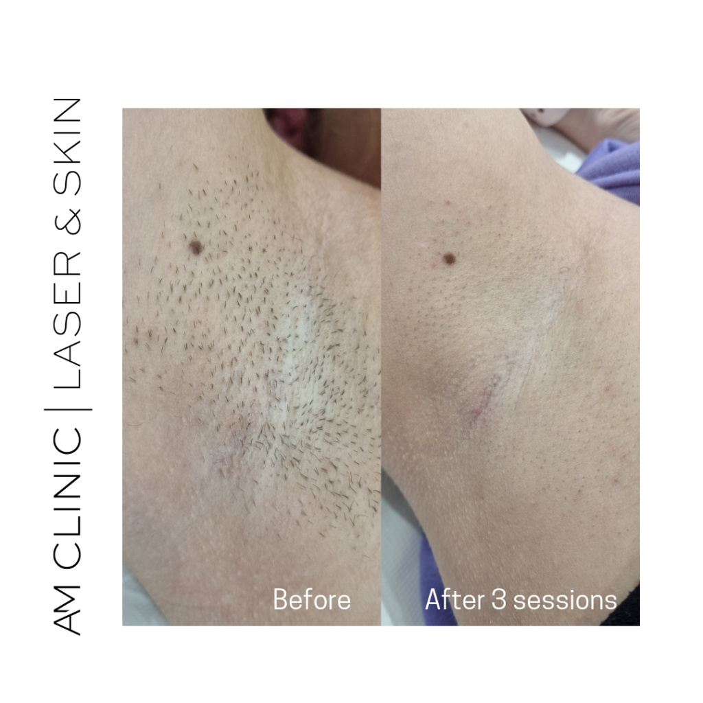 laser hair remove armpit before and after