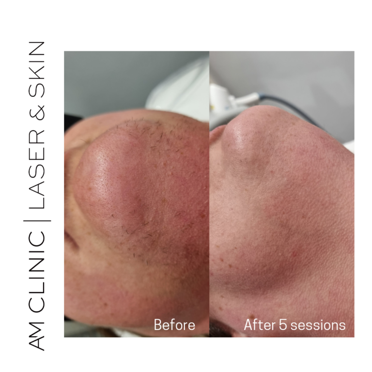 laser hair remove chin before and after 5 sessions