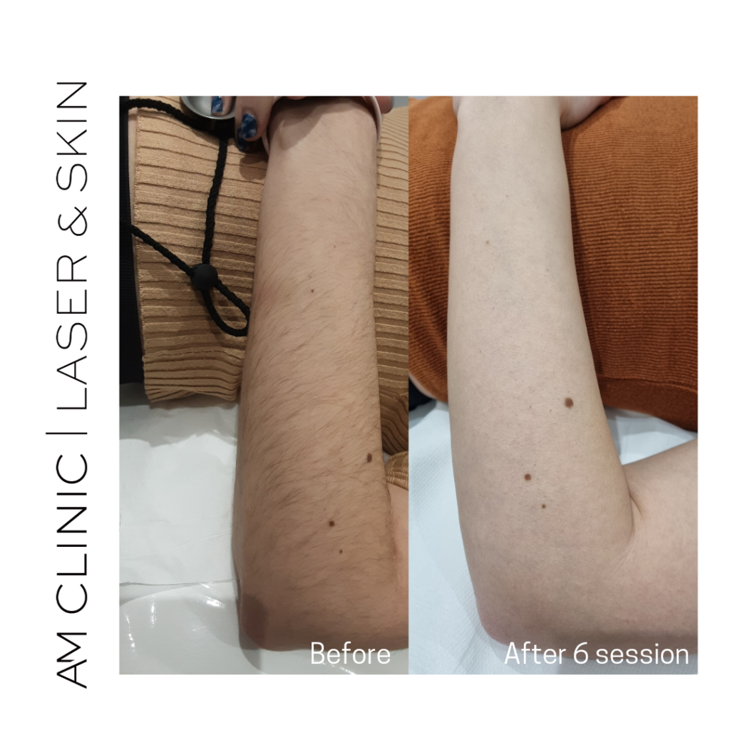 laser hair remove arms before and after 6 sessions