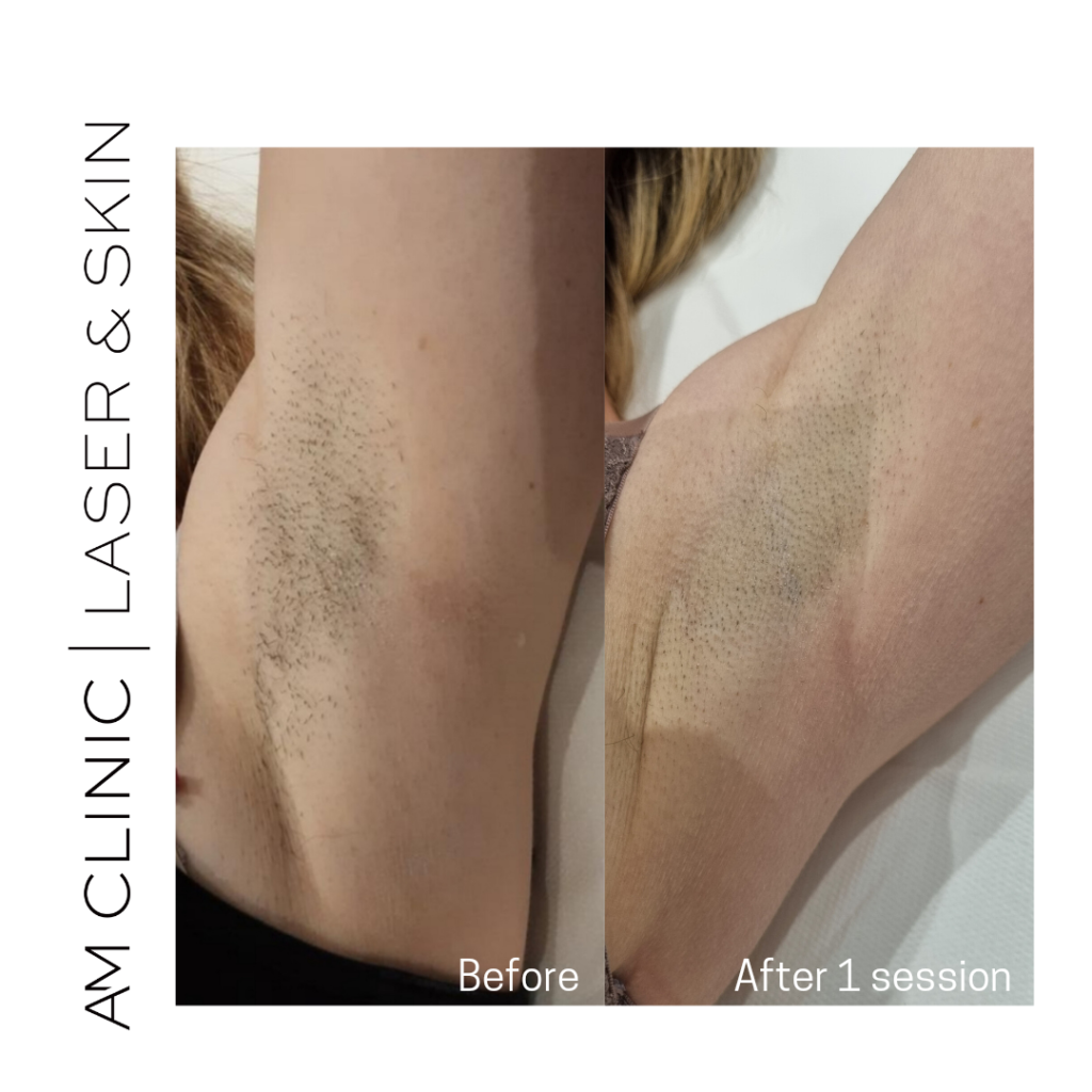 laser hair remove armpit before and after 1 session