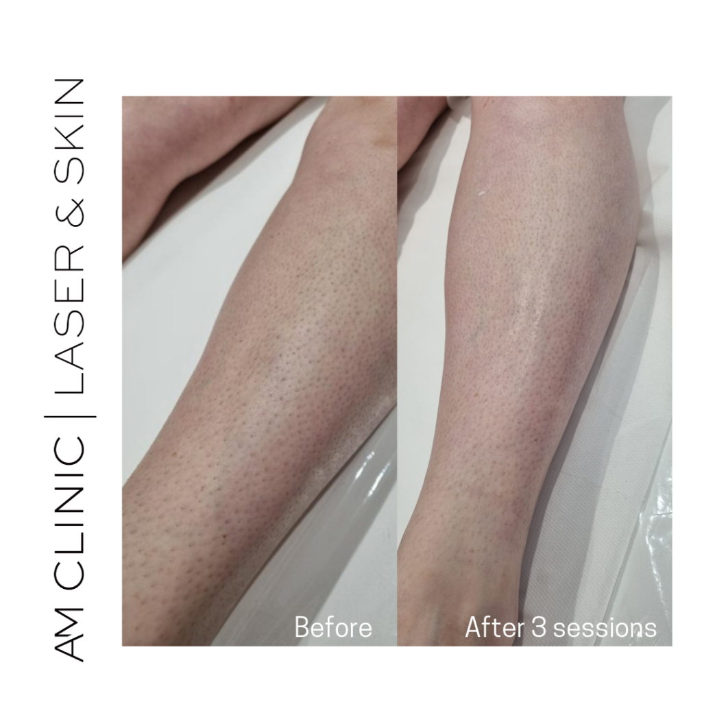 laser hair remove legs before and after 3 sessions