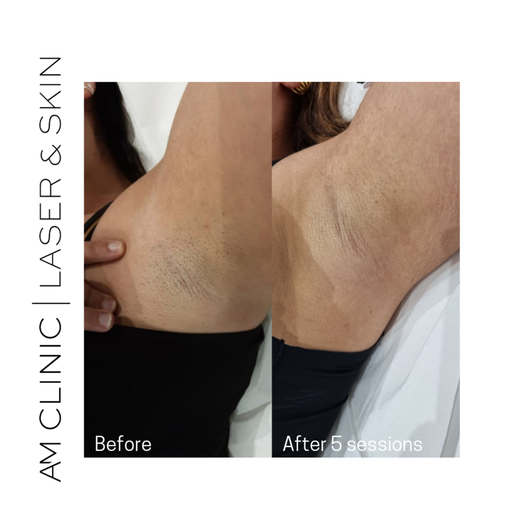 laser hair remove armpit before and after 5 sessions