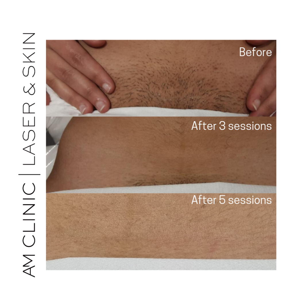 laser hair remove of bikini line before and after